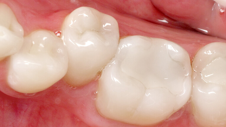 Image representing Kinetic Tooth Preparation