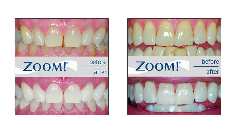 Image representing One-Hour ZOOM! Whitening